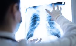 “Ciğerlerde kalan Covid-19 nodülleri akciğer kanseri başlangıcı olabilir”